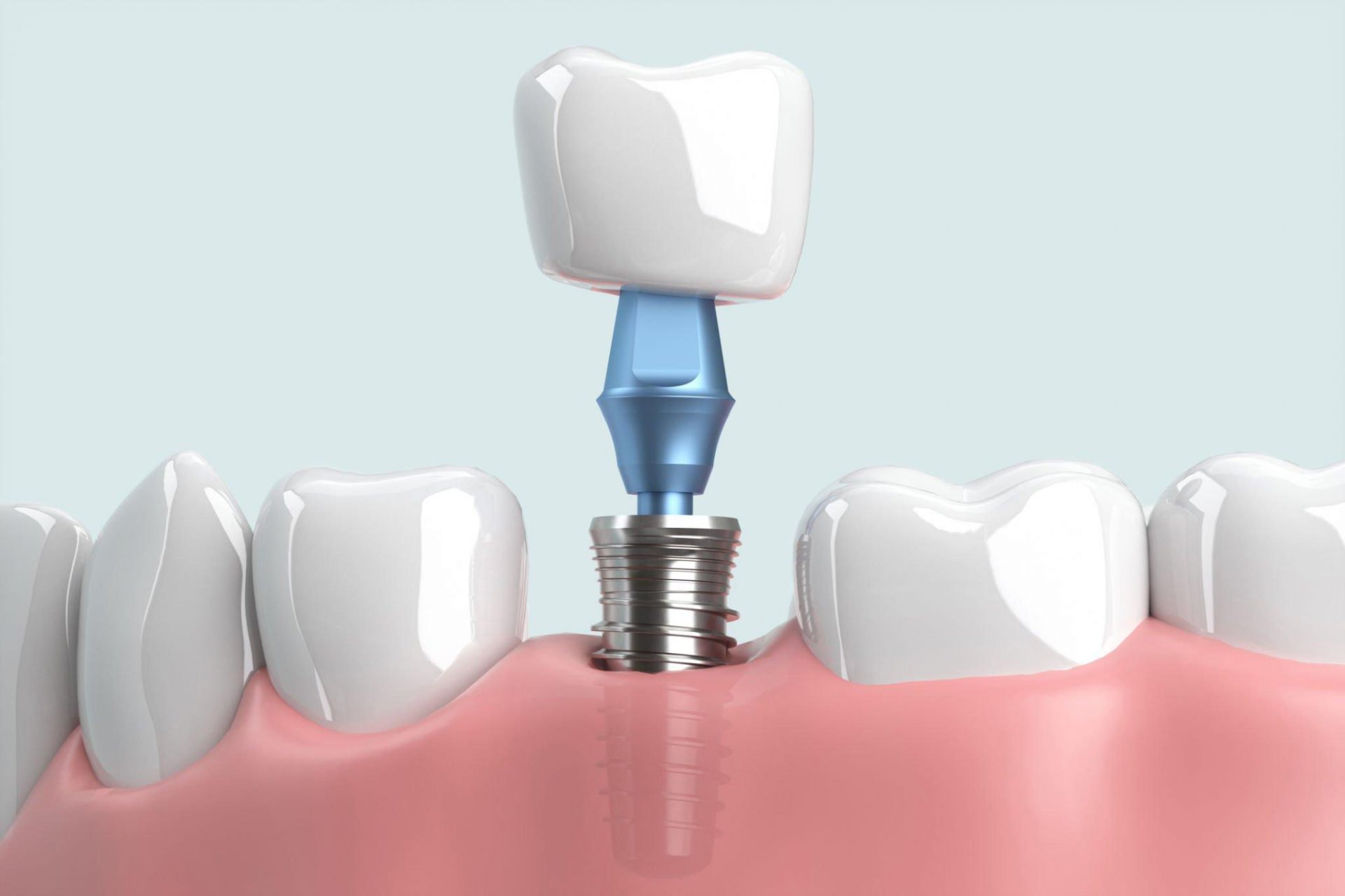 trồng răng implant có vĩnh viễn không
