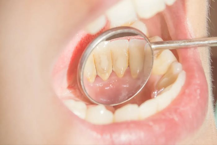[Hỏi – Đáp] Lấy cao răng có được bảo hiểm y tế không?