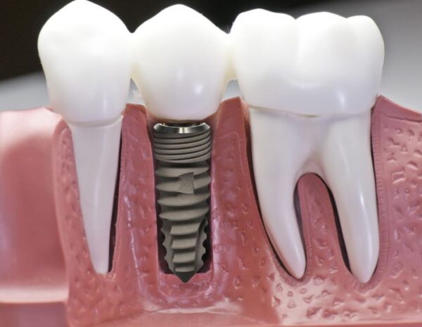 trồng răng implant nguy hiểm không